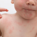 Protege la salud de tus hijos con alergias alimentarias: consejos prácticos y efectivos